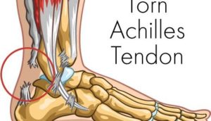 torn achilles 550x315 1