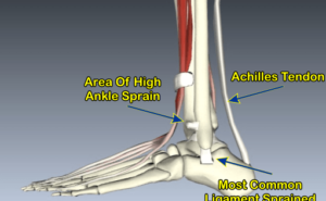high ankle sprain 511x315 1