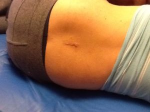 microdiscectomy