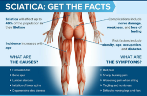 physiofit sciatica 1