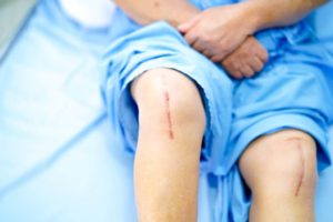 knee replacement 135619367 1024x683 1